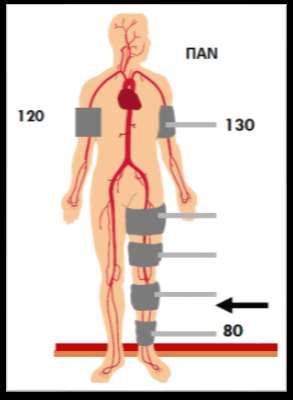 Τι είναι ο σφυρο-βραχιόνιος δείκτης; Η μέτρηση της αρτηριακής πίεσης στα σφυρά γίνεται με ένα απλό πιεσόμετρο και