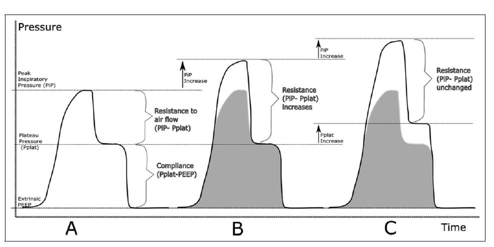 Asthma ventilation: high pressures troubleshooting Normal Increase in