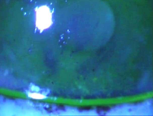 Επίδραση στην δακρυϊκή στοιβάδα Λιπιδική Στοιβάδα Brake lipids Lid margin keratinization - MGD Υδάτινη Στοιβάδα Epithelial cell damage Βλένη Goblet cell damage Καλυκοειδή Κύτταρα - (MUC) MUC (-)