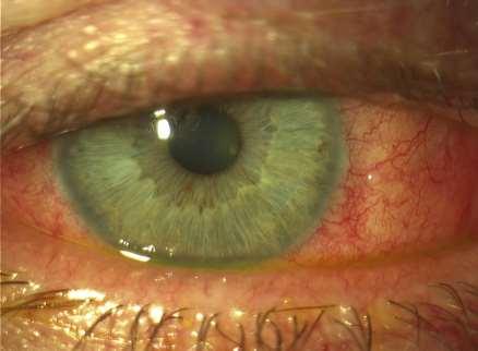 Νόσος Οφθαλμικής Επιφάνειας (OSD) «Κόκκινο Μάτι» Η Νόσος Οφθαλμικής Επιφάνειας είναι το συχνότερο