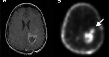 MRI και 11 C-Choline-PET σε πλειόμορφο
