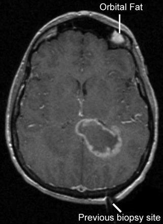 MRI, αλλά και παθολογική πρόσληψη σε εστία