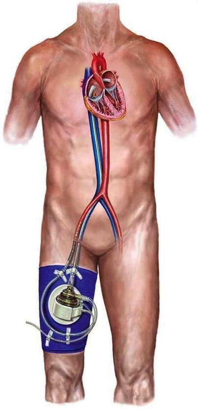 Percutaneous Cardio- Pulmanory Support ΔΝΓΔΙΞΔΙ - Ομεία απόθξαμε αγγείνπ