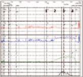 channels Αizawa N & Igawa Y Investig Clin Urol 2017;58(Suppl):S82 Υπολειτουργικός εξωστήρας UD σε με LUTS 40% (48% σε > 70 χρ.) UD σε με LUTS 13% (45% σε > 70 χρ.