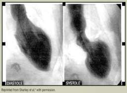 Μυοκαρδιοπάθεια Takotsubo Η μυοκαρδιοπάθεια Takotsubo, είναι μια ταχέως αναστρέψιμη μορφή της οξείας καρδιακής ανεπάρκειας η οποία κλασικά ενεργοποιείται από στρεσογόνους παράγοντες - κορυφαία