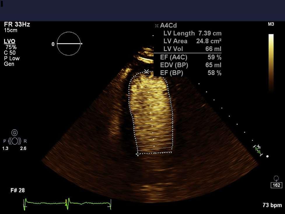 End-diastolic endocardial tracing obtained from the apical four-chamber view after the
