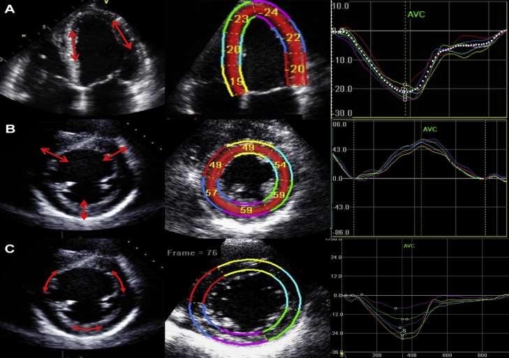Speckle Tracking Echocardiography-Based Peak Systolic Strain Measurements in a Patient With Breast Cancer Prior to Initiation of Cytotoxic Chemotherapy (A) Global longitudinal strain (GLS), (B)