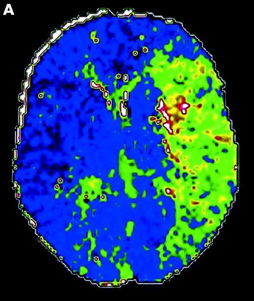 Perfusion CT (time to peak