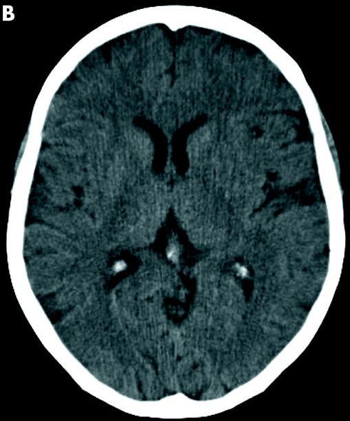 MCA ischaemia sub-three