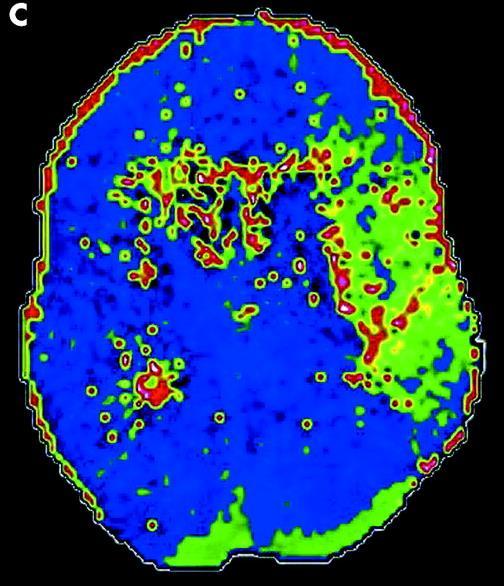 Perfusion CT predicts final