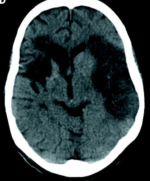 arterial recanalisation: three