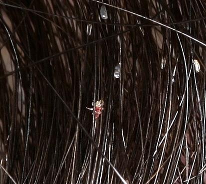 Τάξη Anoplura Pediculus capitis Ψείρα κεφαλής