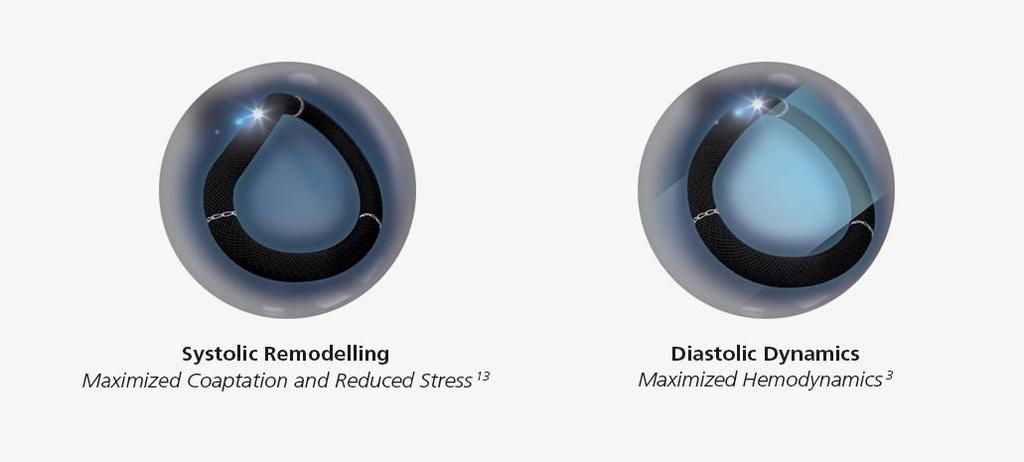 Physiologic saddle shaping concept The true physiological 3D motion of the ring during the cardiac cycle preserves the natural non-planar geometry saddle shape of the annulus.