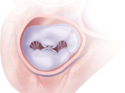 Remodeling annuloplasty Type II: increased leaflet motion