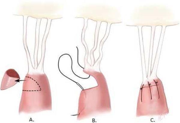 papillary muscle sliding plasty Papillary muscle