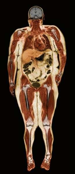 Dyslipidemia Hypertension Gynecologic abnormalities