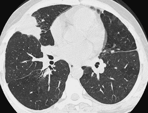 High resolution computed tomography (HRCT) scan Patient with chronic granulomatous disease, nonproductive cough, and pleuritic chest pain.