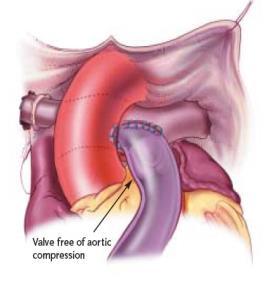 Σοβαρή επιπλοκή αποτελεί η περιφερική στένωση με πιθανούς μηχανισμούς: 1) Υποπλασία ή περιφερική στένωση των κλάδων της πνευμονικής αρτηρίας.