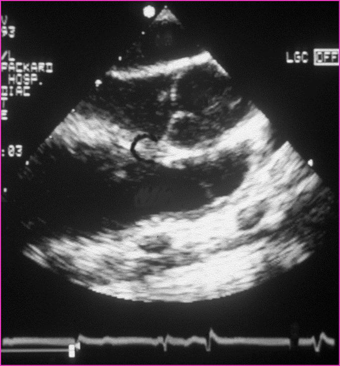 BIVENTRICULAR ORIGIN INFUNDIBULAR PULMONARY