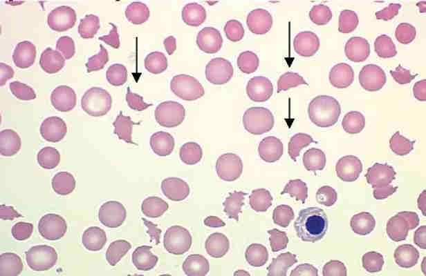 bite cells, Heinz bodies σε συνδυασµό µε φυσιολογικό G6PD αποκλείει την νόσο υσπλασία