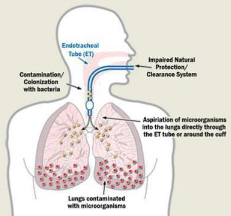 Παθογένεια της VAP (μηχανισμοί) Αποικισμός της αναπνευστικής και γαστρικής