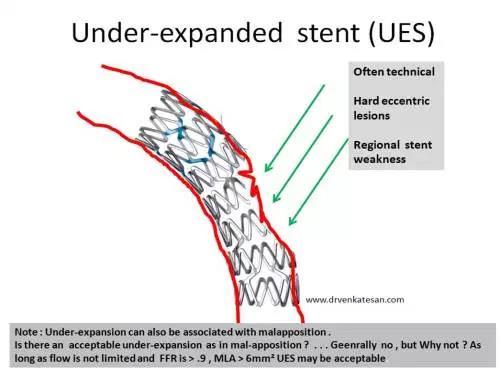 PERCUTANEOUS CORONARY INTERVENTION (PCI) H έντονη επασβέστωση των στεφανιαίων αγγείων συμβάλλει σε τεχνικές δυσκολίες στην τοποθέτηση των stents (stent under-expansion), που οδηγούν συχνά σε