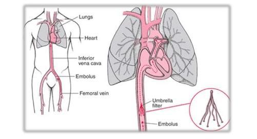 ΦΙΛΤΡΑ ΚΑΤΩ ΚΟΙΛΗΣ ΦΛΕΒΑΣ Σε ασθενείς με απόλυτη αντένδειξη για αντιπηκτικά