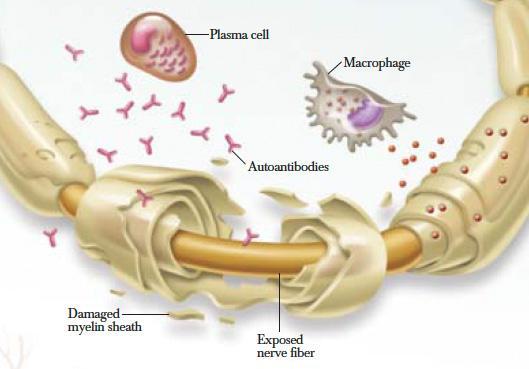 Guillain-Barré Syndrome (GBS) Οξεία περιφερική πολυνευροπάθεια ανοσολογικής αρχής Ετήσια επίπτωση 0.89-1.89/100.