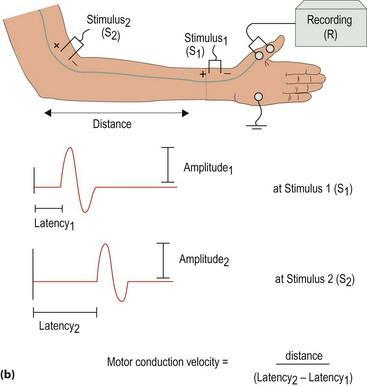 NERVE CONDUCTION STUDIES Demyelination CV