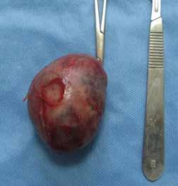 Surgical preparation of a movable thyroid carcinoma after thyroidectomy. as to avoid trumatising these nerves. 7. The blood vessels surrounding the gland are ligated.