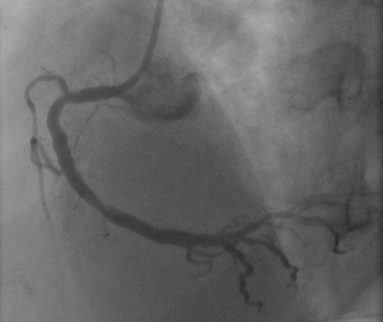 IVUS RCA IVUS: Πιθανώς