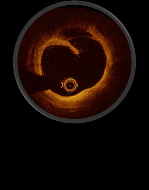 το IVUS (10 vs.