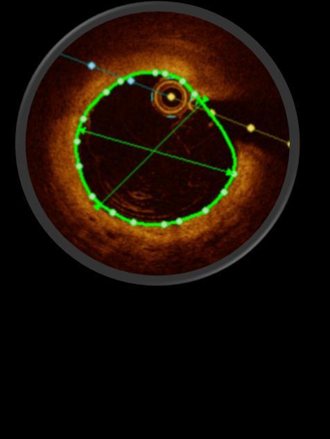 επιλογής stent Distal/Proximal