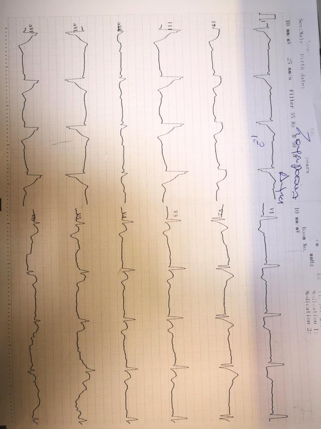 Αρχικό HΚΓ 1 st ECG 2:10 a.m.