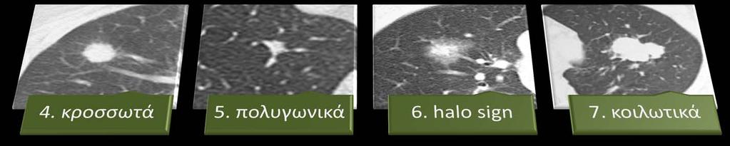 characteristics on HRCT.