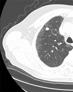 solid part nodules that