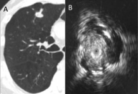 βρογχοσκόπηση: κατευθυνόμενη radial endobronchial ultrasound (R-EBUS) καθετήρας με κεφαλή υπερήχων εικόνα 360 πέριξ ιστών o o εντοπισμός όζου (διαδοχική είσοδος καθετήρα σε ύποπτα στόμια) διαβρογχική