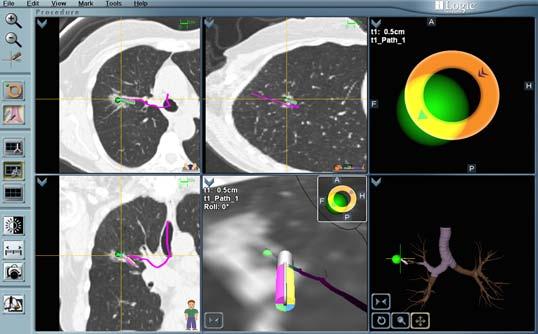 βρογχοσκόπηση: κατευθυνόμενη navigational bronchoscopy (πλοηγούμενη βρογχοσκόπηση) electromagnetic navigation