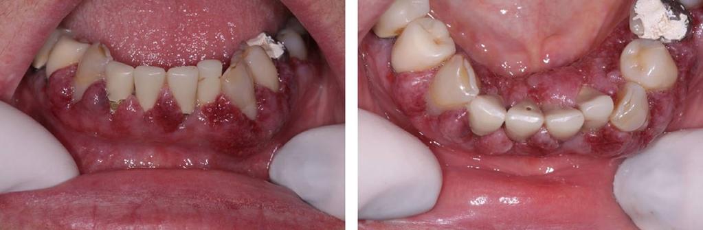 Gingival granulomatosis with polyangiitis currently under control. Palpable lymph nodes were not found during regional physical evaluation.