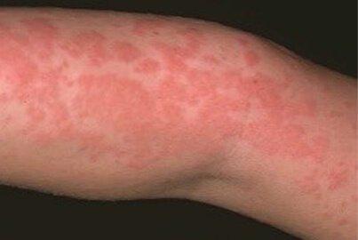 Άλλες μεταβολές του δέρματος μπορεί να περιλαμβάνουν ερυθρότητα και κνίδωση που εμφανίζονται επίσης σε λιγότερο σοβαρές αλλεργικές αντιδράσεις.