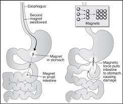Μαγνήτες Ανησυχούμε όταν > 1 Κίνδυνος Εντερο-εντερικού συριγγίου