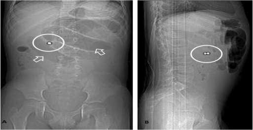 X-rays αν πρόκειται για έναν ή