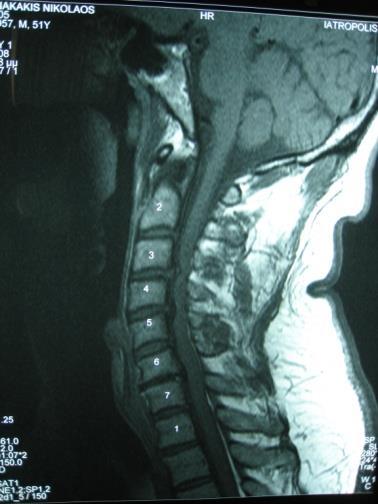 Μαγνητική τομογραφία (MRI) Είναι ακίνδυνη μέθοδος, ο ασθενής δεν δέχεται ακτινοβολία, αλλά εξακολουθεί να