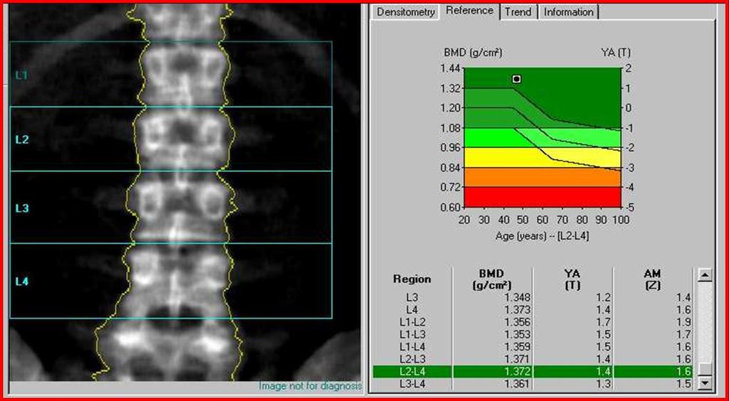 κατά την οποία μετράται η οστική μάζα των οσφυϊκών