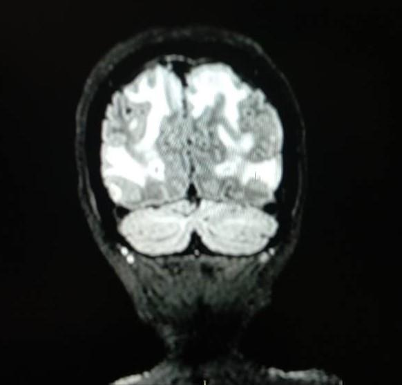 φ. ΟΝΠ: φυσιολογικό ΕΝΥ MRI brain: PRES #4 low