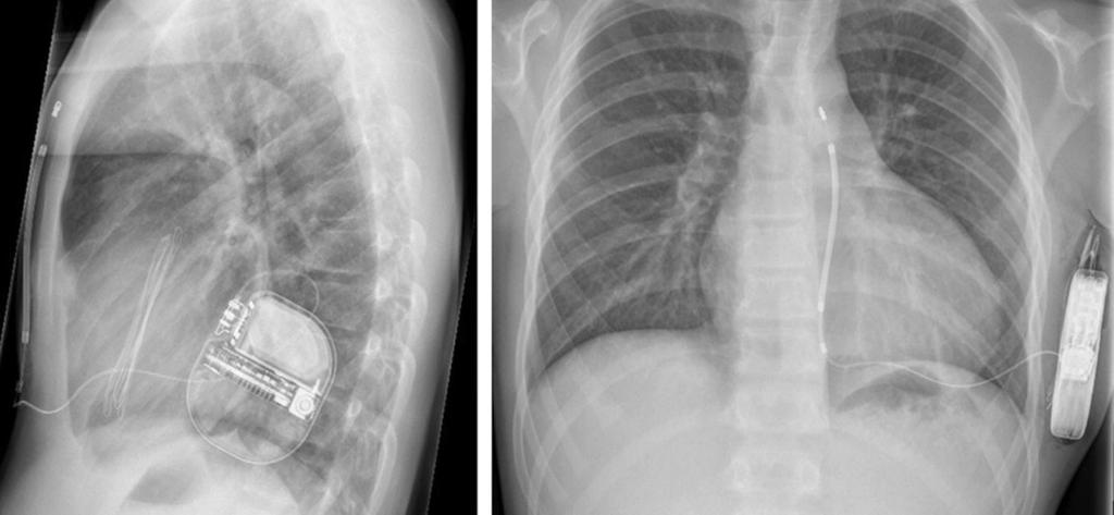 HCM: Υποδόριος ICD Bettin M et al, JACC