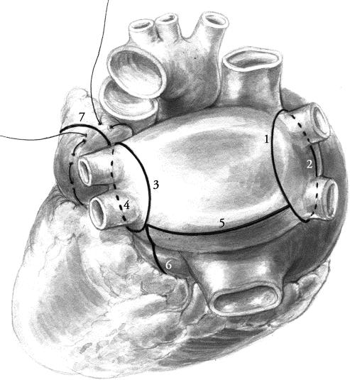 Operative Technique 1 st Line of Ablation: Posterior wall of Right Pulmonary Veins 2 nd Line of Ablation: Anterior wall of right PVs 3 rd Line of Ablation: Posterior wall of Left PVs 4 th Line of