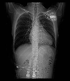 New Strategy of VAD therapy Bridge to transplantation (BTT) Bridge to recovery (BTR)