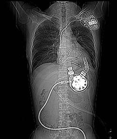 VAD Bridge to bridge implantable VAD Bridge to therapy BTR Bridge to candidacy BTT