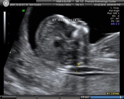Εικόνα 22. Αυξημένη αυχενική διαφάνεια σε έμβρυο 12 εβδομάδων και 5 ημερών.
